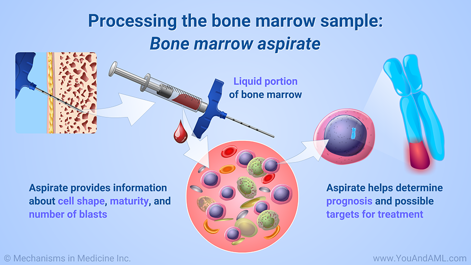 Processing the bone marrow sample: Bone marrow biopsy