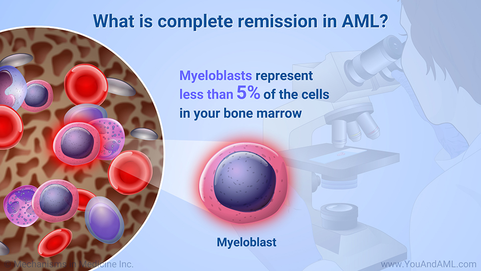 What is complete remission in AML?