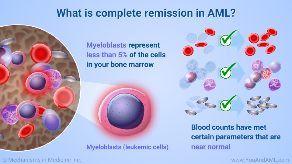 What is complete remission in AML?