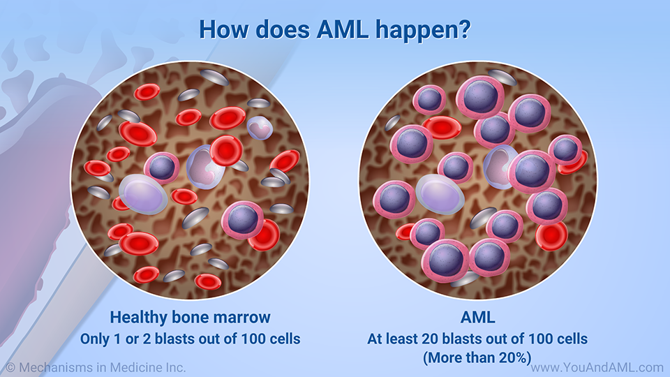 How does AML happen? (Continued)